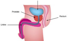 Cancer de la prostate: les symptômes à repérer, les facteurs pour l’éviter.