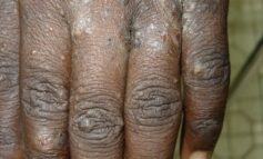 Le MSPP alerte sur la présence d’une maladie contagieuse de la peau