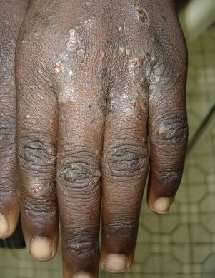 Le MSPP alerte sur la présence d’une maladie contagieuse de la peau